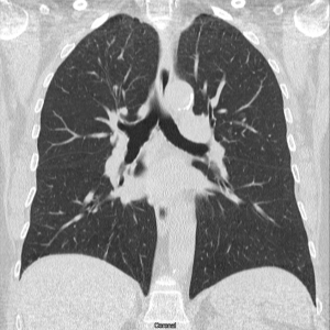 Lung3